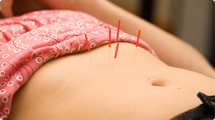 A young woman receives acupuncture treatment to her abdomen