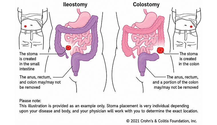 Medical illustration showing the differences between Ilestomy and Colostomy