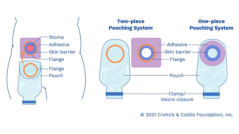 Medical illustration showing the parts of an ostomy pouch