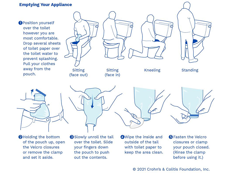 Medical illustration showing various positions for, and the five steps in, emptying an ostomy appliance