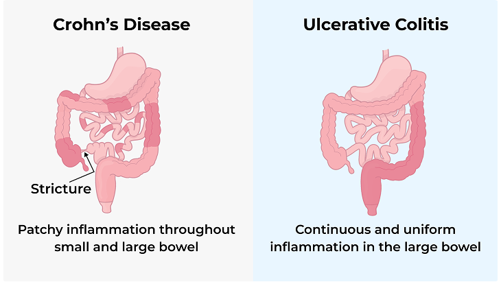 Crohns Disease Vs Ulcerative Disease Image