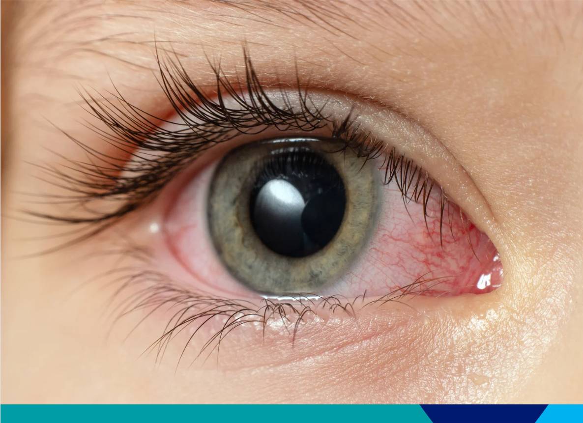 close up of a bloodshot eye