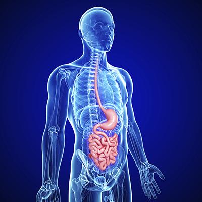Medical illustration of chronic intestinal inflammation from Crohn’s disease and other inflammatory bowel diseases