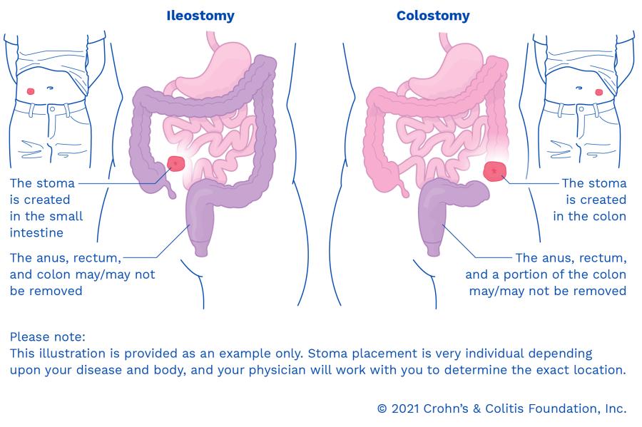 Diet Tips for Managing a Colostomy or an Ileostomy | Byram Healthcare
