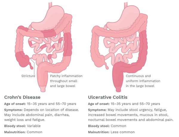 Overview of Crohn's Disease  Crohn's & Colitis Foundation
